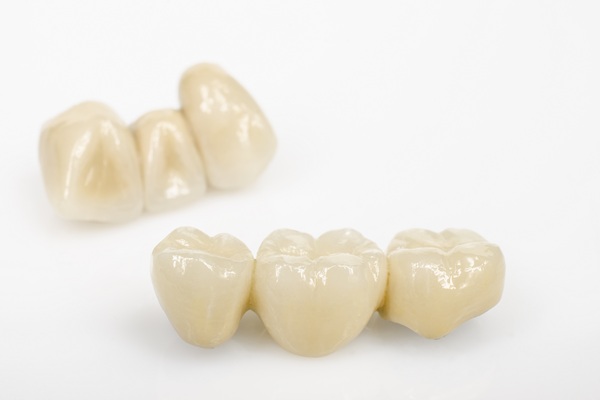 Benefits Of Dental Bridges