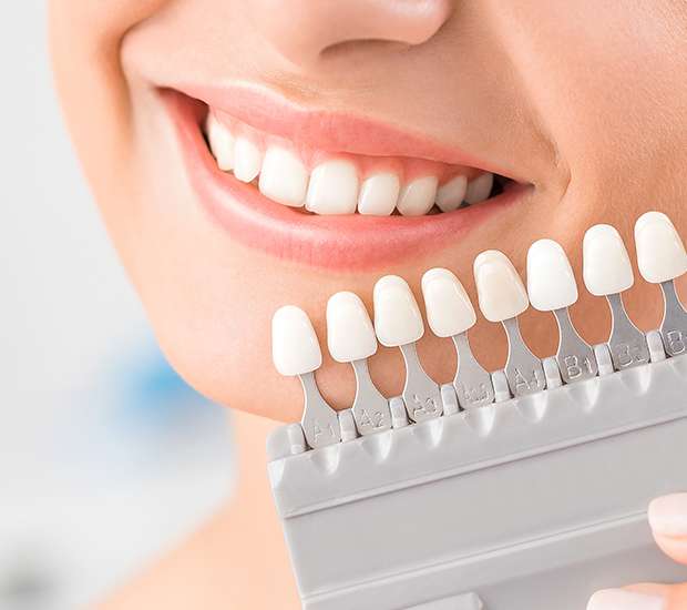 Albany Dental Veneers and Dental Laminates