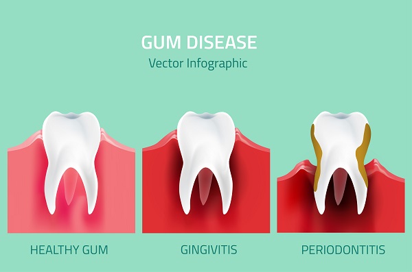 Gum Disease Prevention Tips