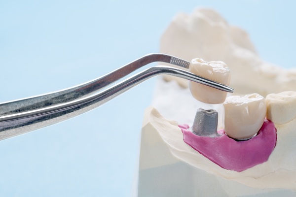 Implant Crowns: A Natural Looking Dental Restoration