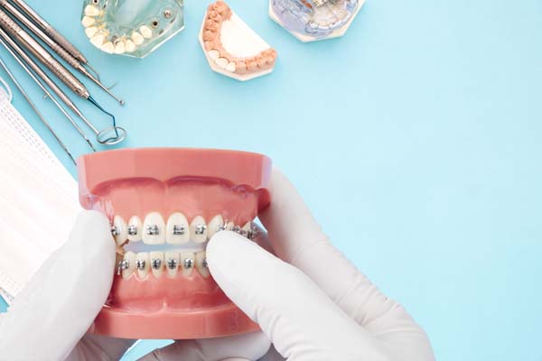 Pros And Cons Of Braces For Orthodontics