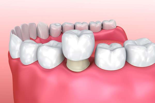 Permanent Dental Crowns vs. Temporary: Is There a Difference from Elm Street Family Dental in Albany, OR