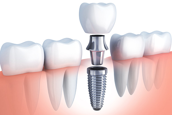 Questions to Ask Your Implant Dentist from Elm Street Family Dental in Albany, OR