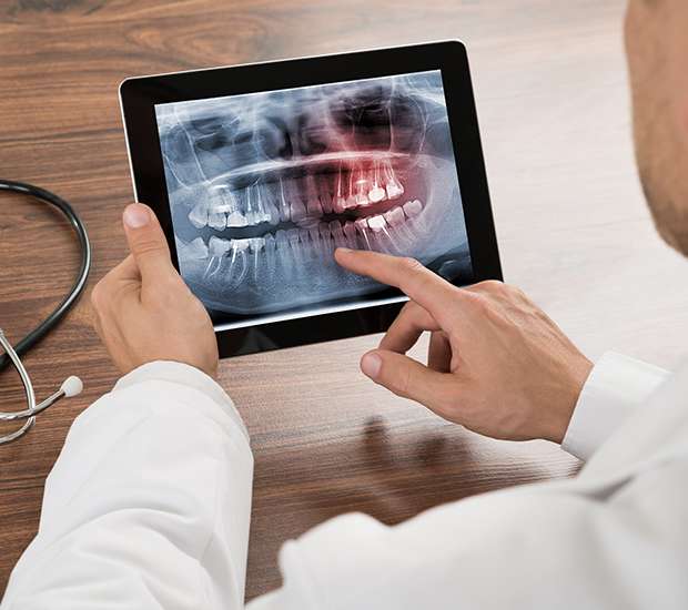 Albany Types of Dental Root Fractures