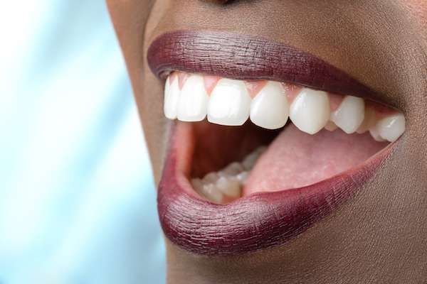 Routine Dental Care: What Are Tooth Colored Fillings from Elm Street Family Dental in Albany, OR